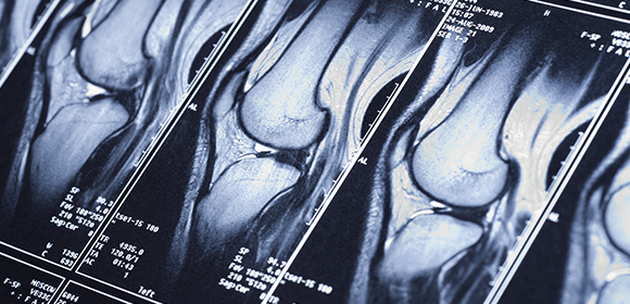 MRI images of the knee