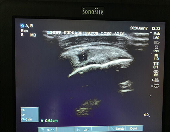 image of ultrasound scan measuring the rotator cuff tear thickness