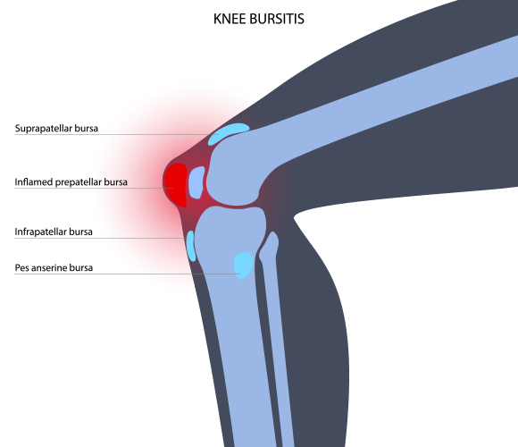 Image showing diagram of anatomy of knee bursitis