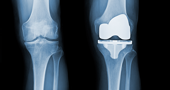 X-Ray of the knee showing replaced knee