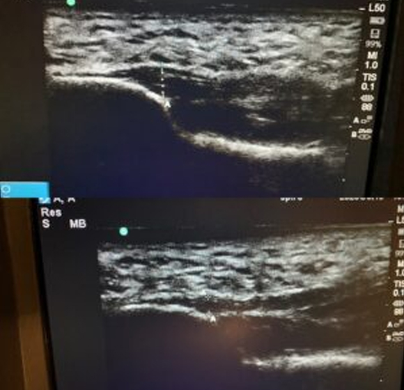 Ultrasound scan image of patients foot