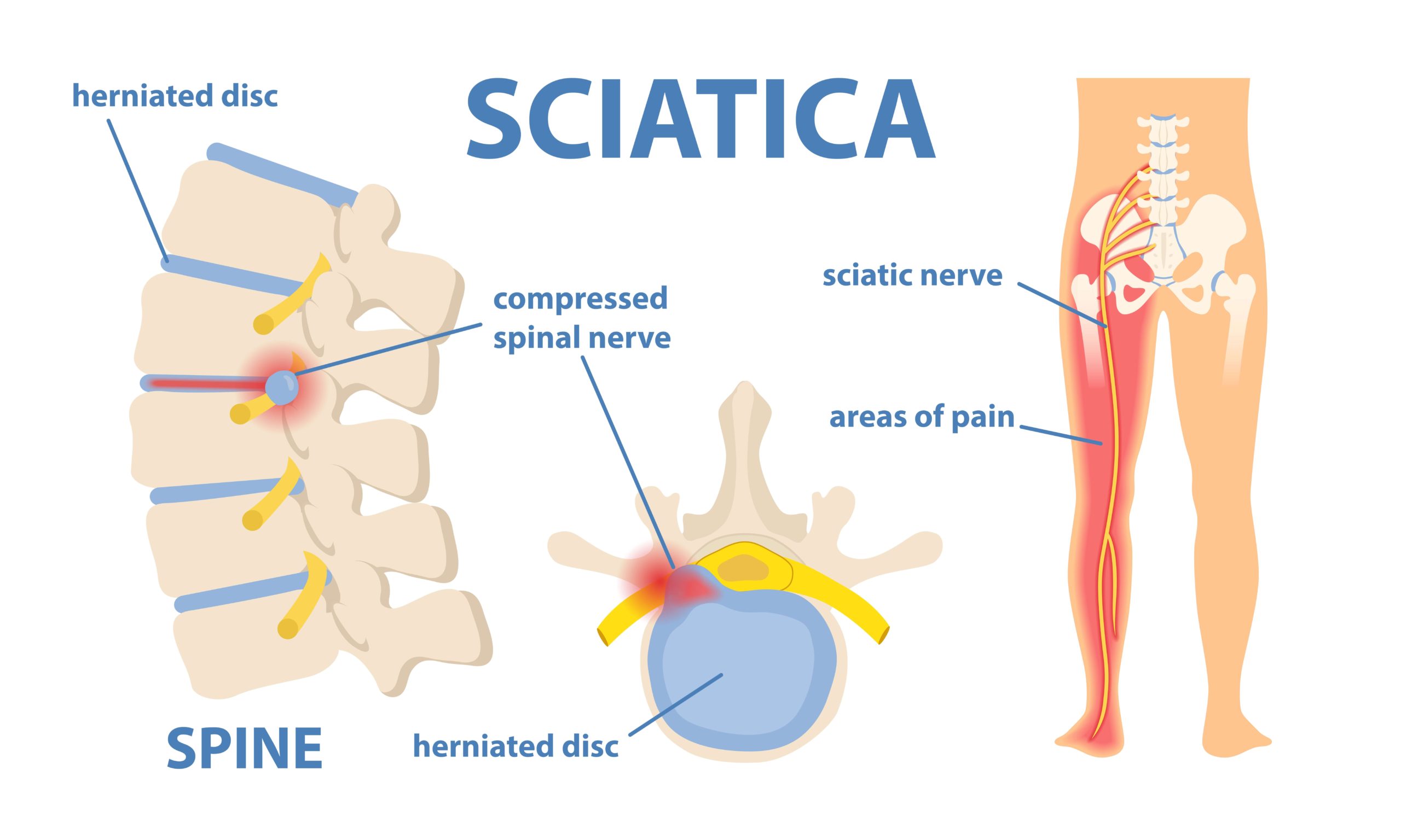 image showing how sciatic nerve pain can be caused via herniated disc