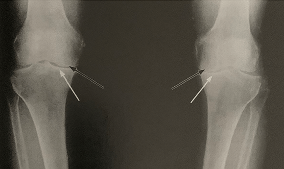 Image of an X-Ray showing what arthritis looks like