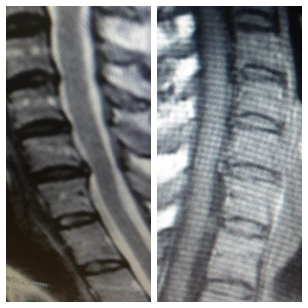 MRI/X-Ray of neck
