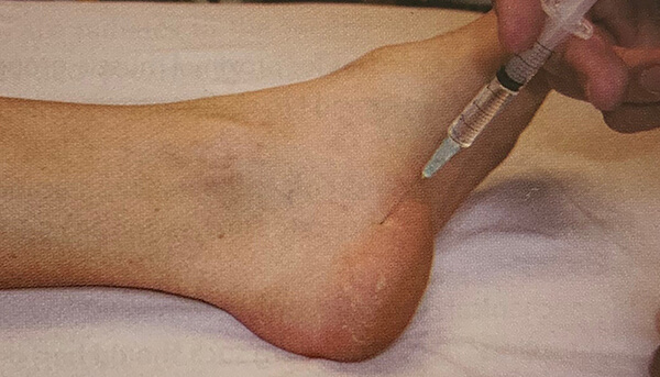 Image of injection into the the foot for treating plantar fasciitis