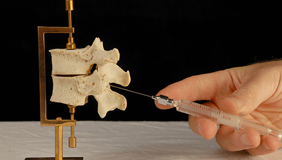 image showing an injection into the facet joint on an anatomy model