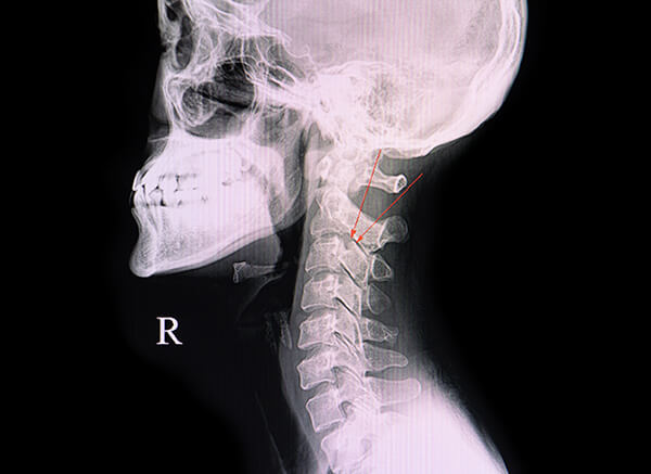 X-ray showing bony spur narrowing the Nerve Root exit