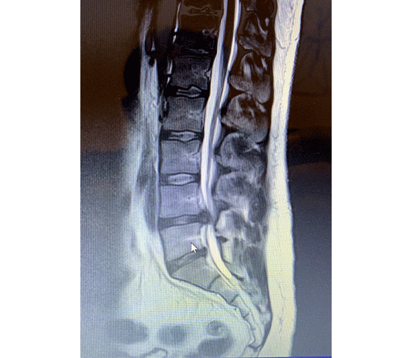 lumbar spine showing spinal stenosis at L4/L5