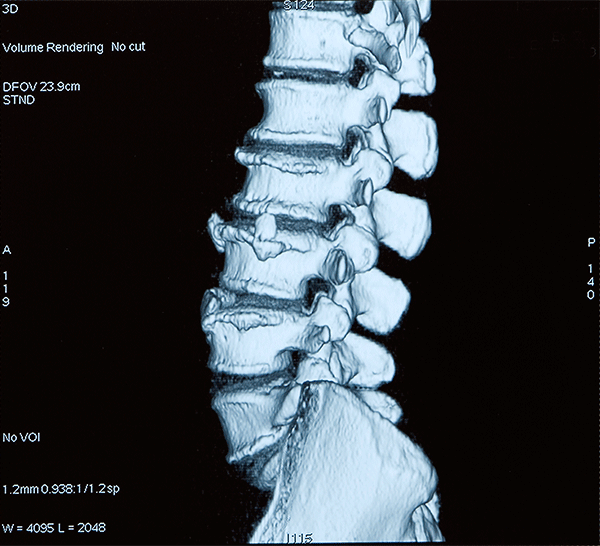 CT spine showing lumbar spondylosis