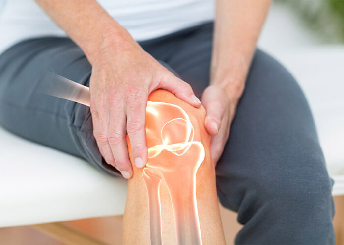Osteoarthritis in Knee Joints