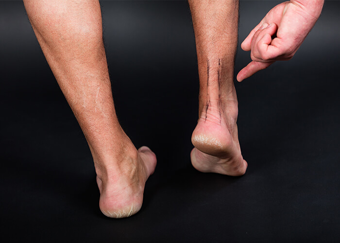 What exercises should one avoid if he has Achilles tendinitis? - Quora