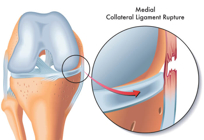 Medial knee ligament injury