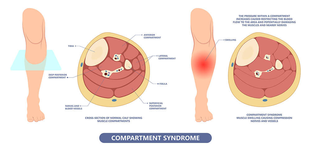 Picture Showing Compartment Syndrome