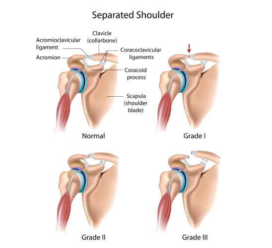 Reverberation Aboard surgeon Shoulder AC Joint Pain MyMSK Clinic Burnley Manchester