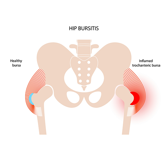 Anatomy of Hip Bursitis