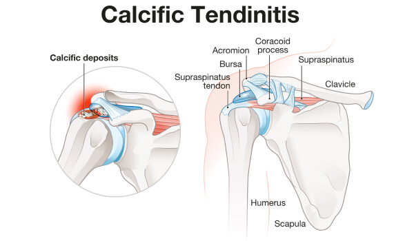 Image displaying anatomy of calcific tendinitis