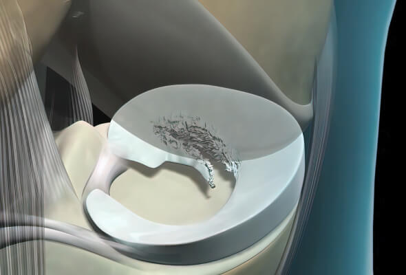 Image showing, in detail, a meniscal tear