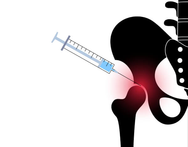 image showing anatomy of Injecting Hip Bursitis