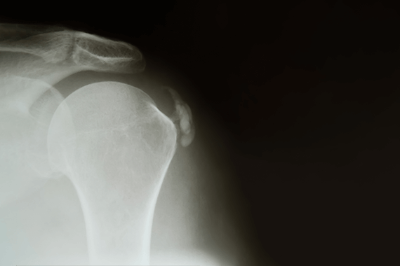 X-ray of Shoulder