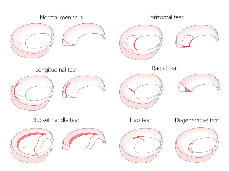 Image showing the different types of meniscus tears