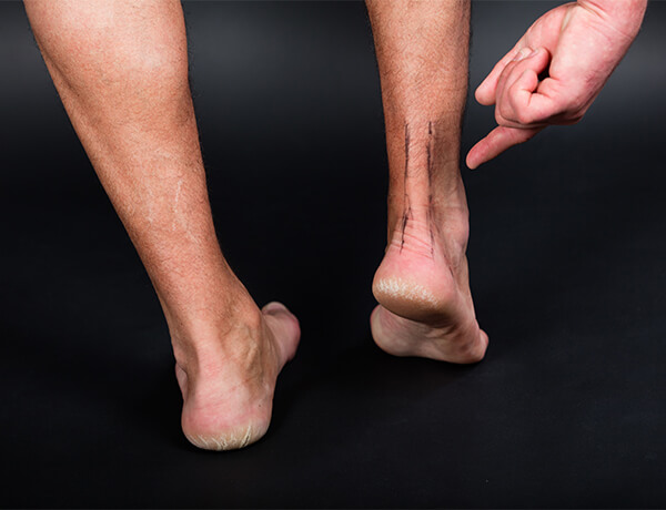 Man pointing at marked Achilles Tendon