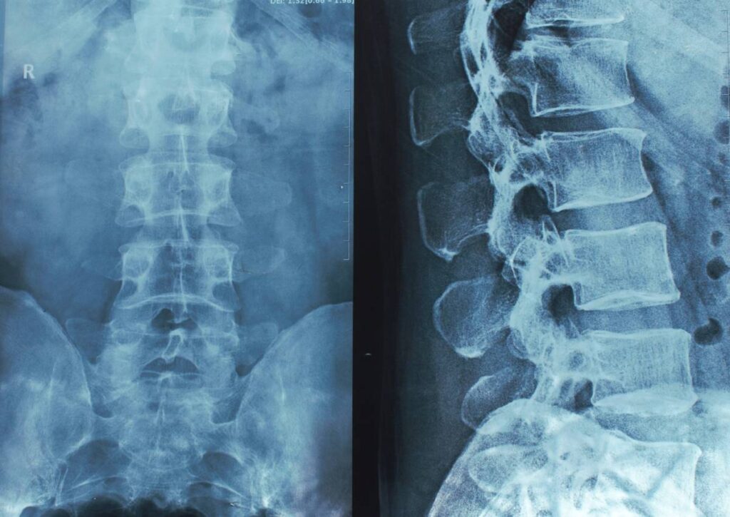 xray picture of lumbar spine and facet joints showing lumbar spondylosis