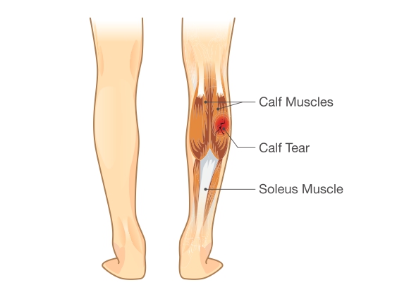 Calf Muscle Strain, Calf Muscle Strain, MYMSK