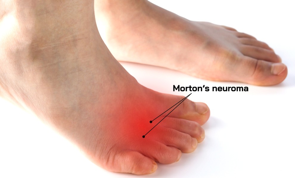 Pain in the foot: Morton's Neuroma l Manchester Burnley