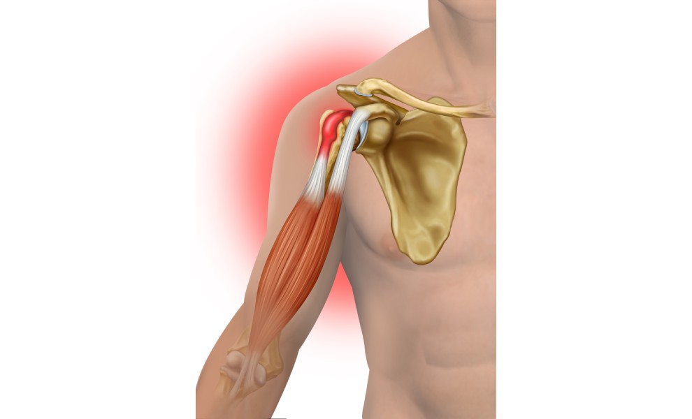Preventing recurrence of biceps tendonitis involves reducing the risk factors that led to the initial injury