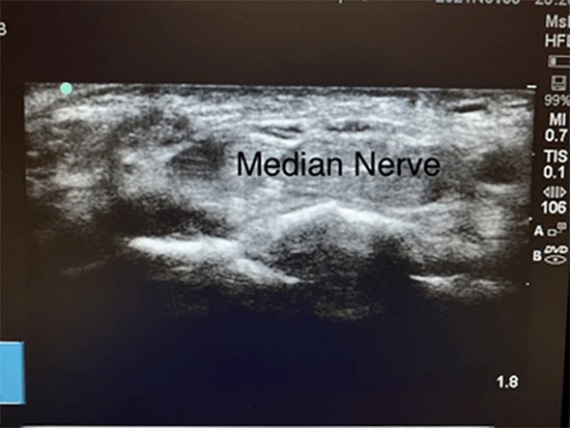 ultrasound of hand nerve related to carpal tunnel syndrome