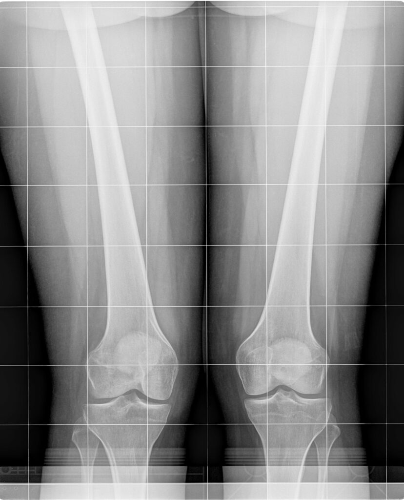 X-Ray of person with Genu-valgum/Knock Knees