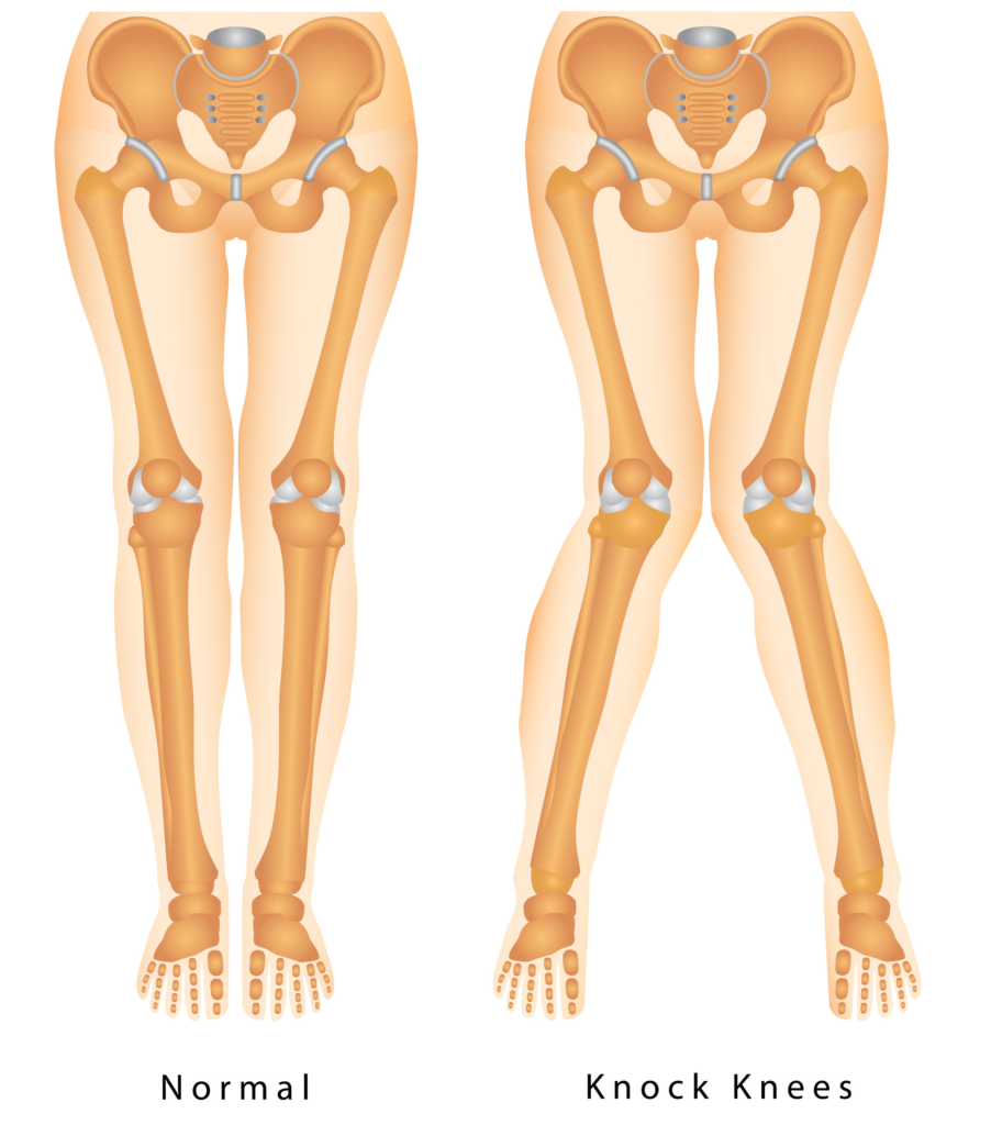 Image to show difference in Normal knees and those with 'Knock Knees'