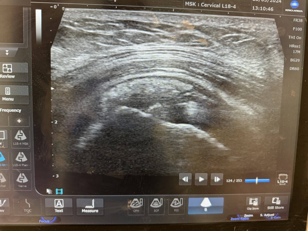 Ultrasound Showing Calcific Tendonitis