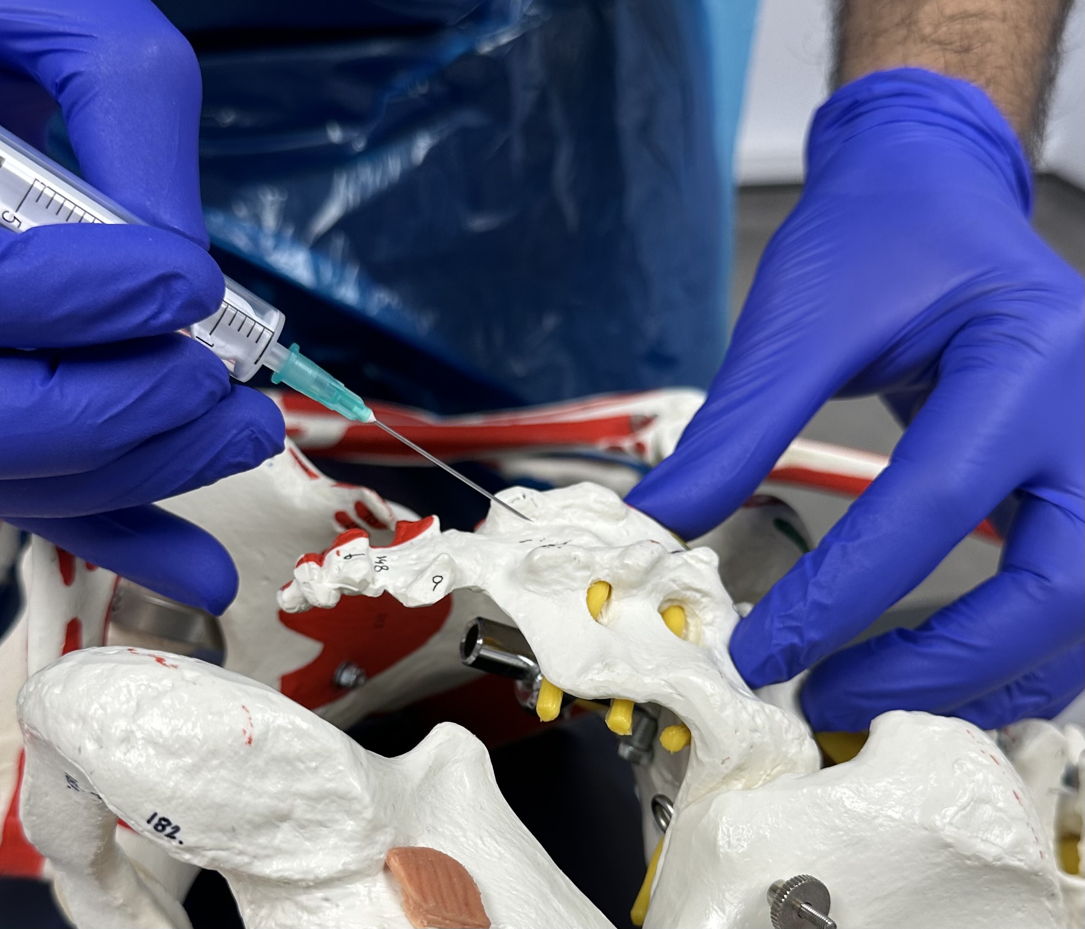 Image of Doctor showing caudal epidural procedure on a anatomy model of the back.