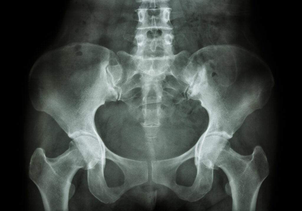 pelvic xray Osteitis Pubis