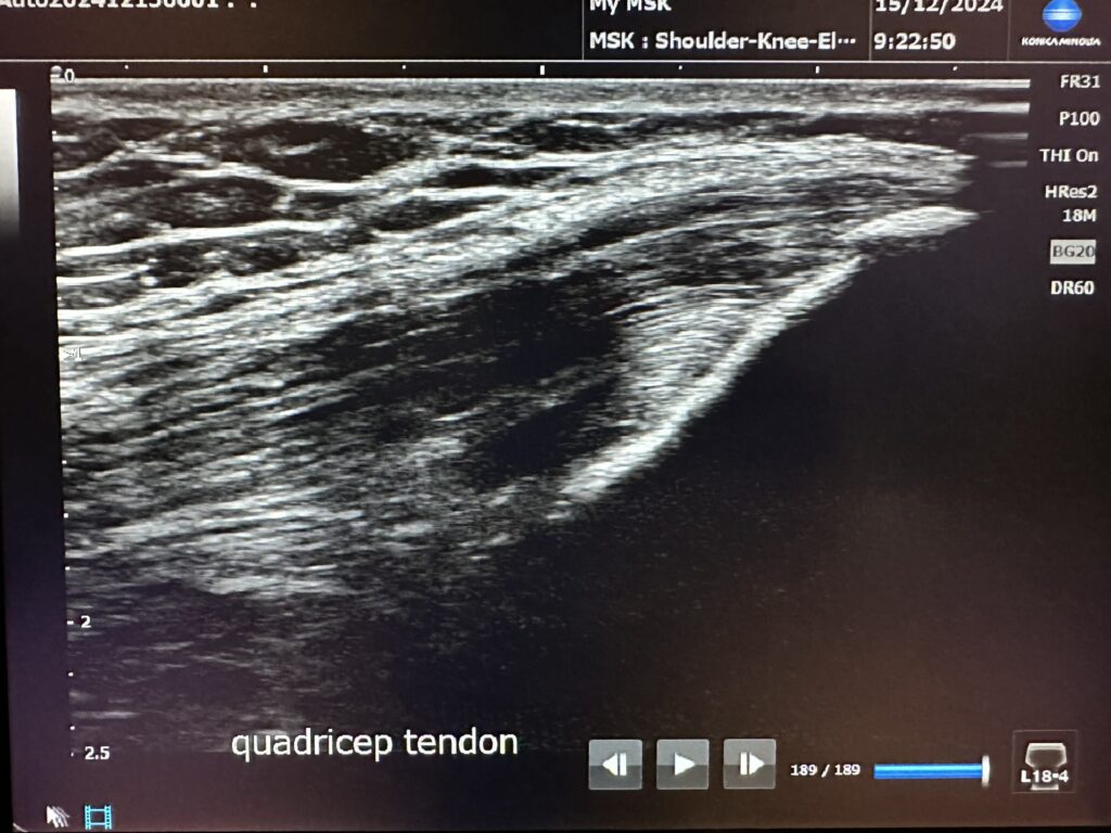 Ultrasound Scan of Quadricep Tendon at the MyMSK Clinic