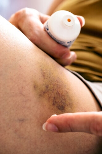 bruising on thigh