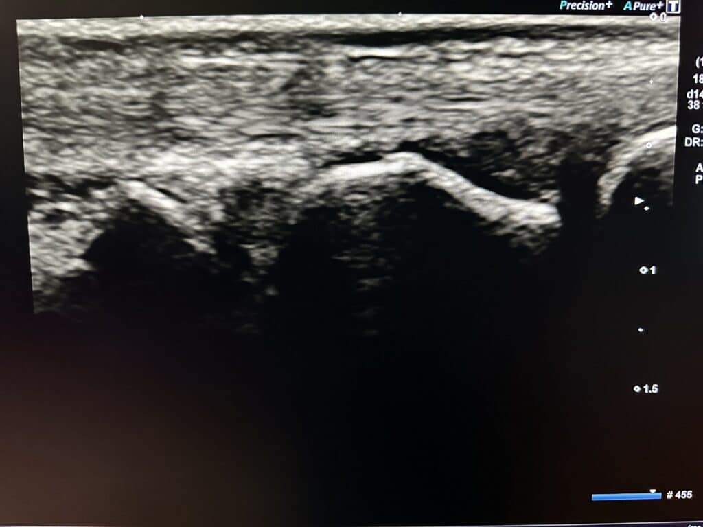 image showing ultrasound scan of hand arthritis