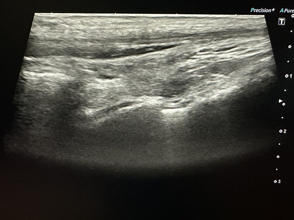 ultrasound image of ankle impingement