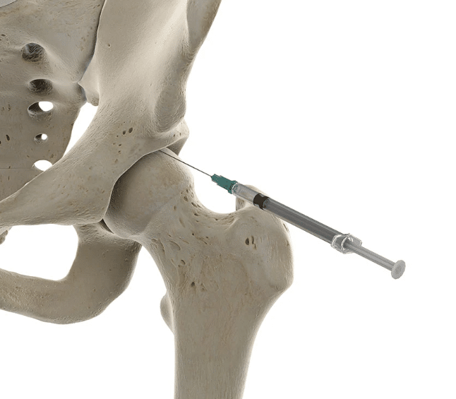 Cortisone injection for hip tendonitis