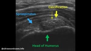 Labelled Ultrasound image showing anatomy of shoulder and calcification