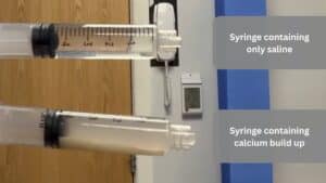 Labelled image showing a syringe with calcium build up inside from calcific tendinitis after barbotage