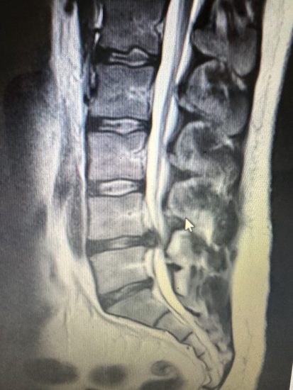 MRI image of a Prolapsed Disc